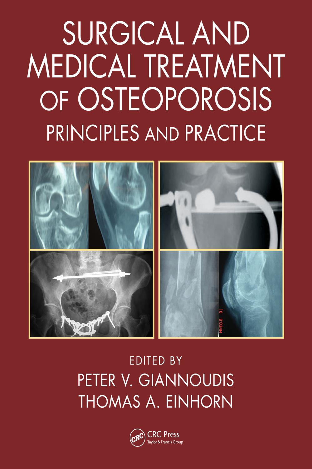 Surgical and Medical Treatment of Osteoporosis: Principles and Practice 1st Edition